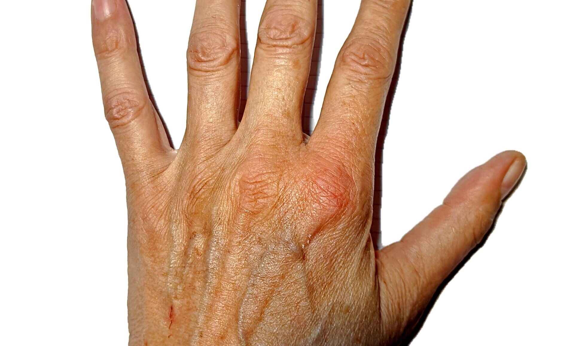 palm 45 min after a bee sting e1723460422269 Palm 45 Minutes After a Bee Sting