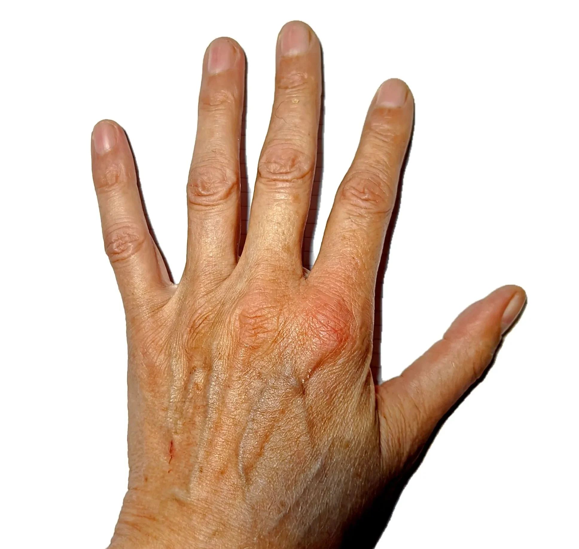 Palm – 45 Minutes After a Bee Sting