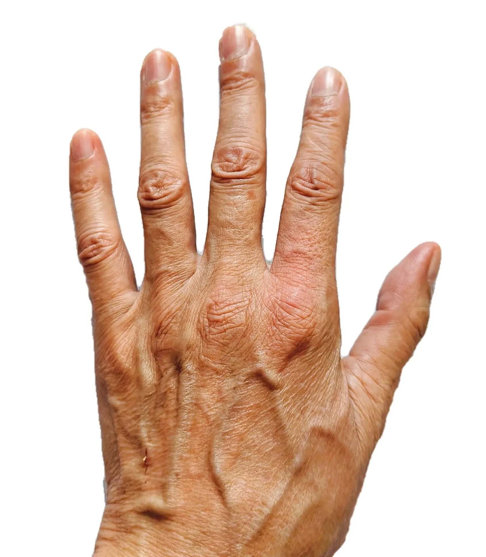 Palm – The Day After a Bee Sting